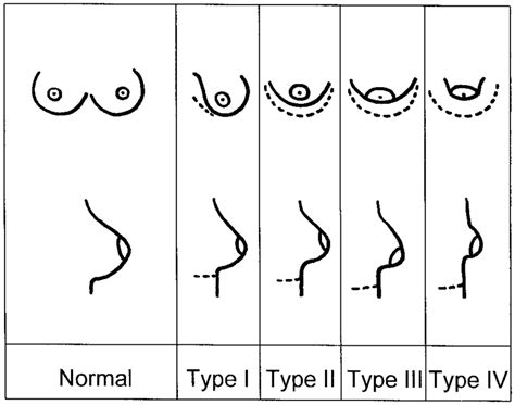 Tuberous breasts .